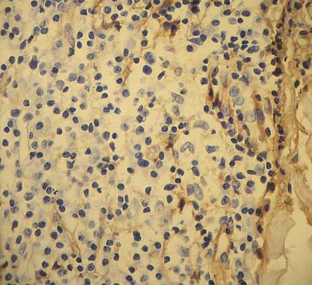 Primary Cutaneous Immunocytoma